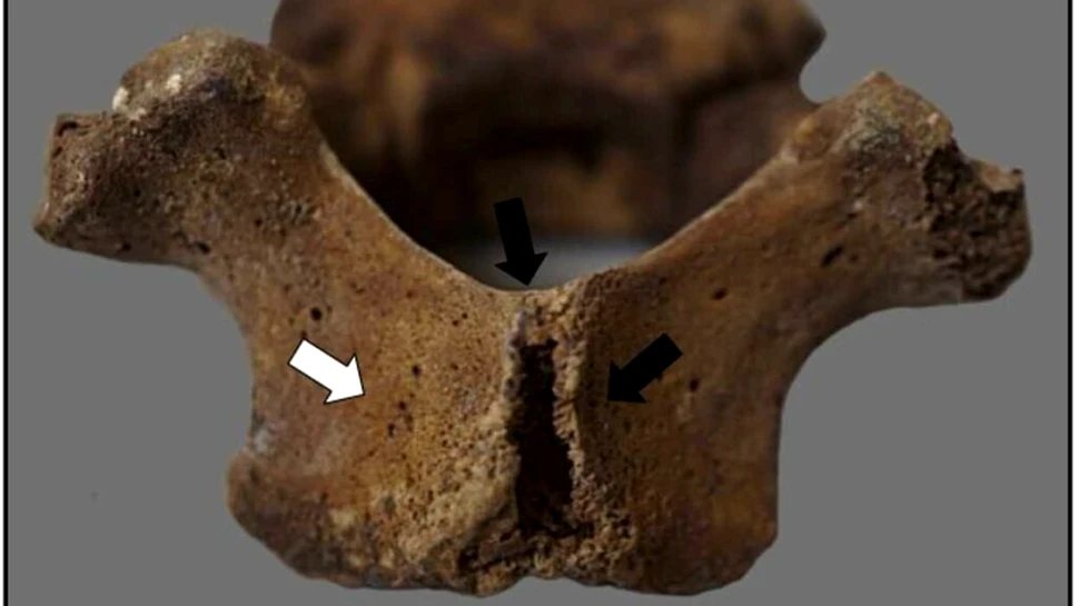 O boală eradicată în zilele noastre a fost găsită pe scheletele copiilor incași