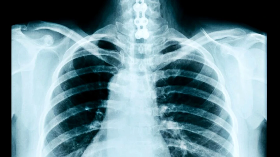 Bolile pulmonare vor putea fi diagnosticate automat cu ajutorul inteligenței artificiale