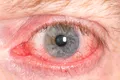 Scanările oculare detectează boala Parkinson cu până la șapte ani înainte de diagnostic