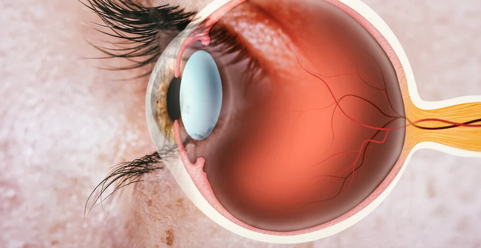 Primul implant de retină artificială efectuat de medicii din Italia