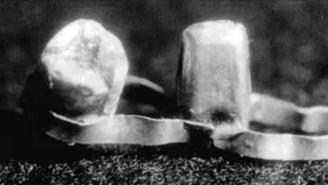 Aparatele dentare nu sunt atât de vechi pe cât s-ar crede