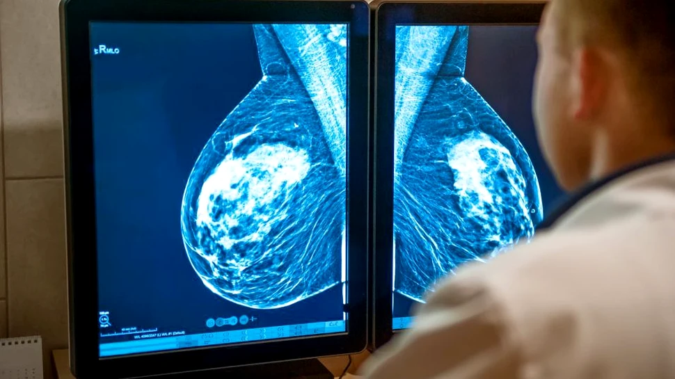 Proteina care joacă un rol important în metastaza cancerelor la nivelul creierului