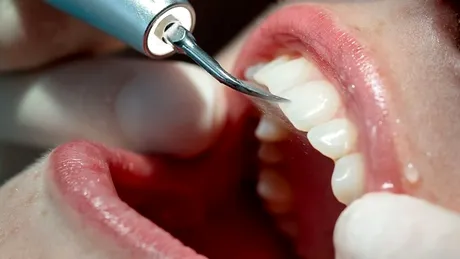 De ce este important detartrajul regulat pentru prevenirea afecțiunilor gingivale (P)