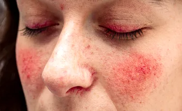 Cancerul de piele, „mascat” de unele boli dermatologice comune