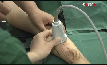 Premieră în lumea medicală: doctorii au transplantat o ureche care a crescut pe antebraţul unui om – VIDEO