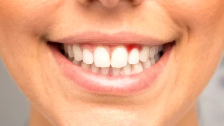 Sângerarea gingiilor ar putea fi un semn precoce al unei afecțiuni mult mai grave