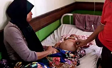 Caz medical rar: unui bebeluş i s-a extirpat din abdomen fratele geamăn