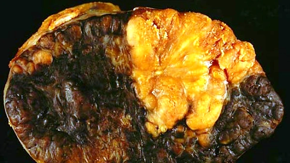 Obligand tumorile sa “imbatraneasca”, am putea invinge cancerul