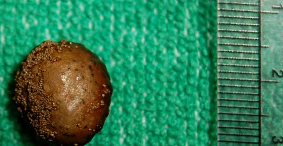Alarmant: tot mai multi copii sufera de pietre la rinichi