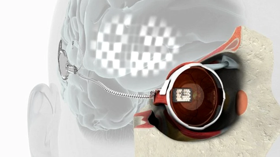 Cercetătorii australieni au reuşit în premieră implantul unui ochi bionic (VIDEO)