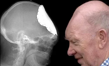Dupa zeci de ani, unui barbat i se dezvolta un nou craniu