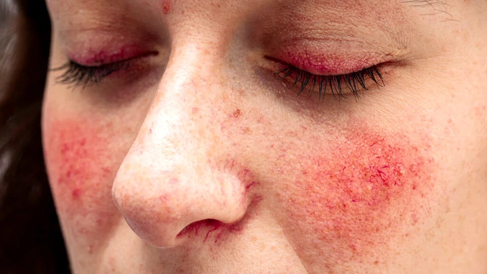 Cancerul de piele, „mascat” de unele boli dermatologice comune