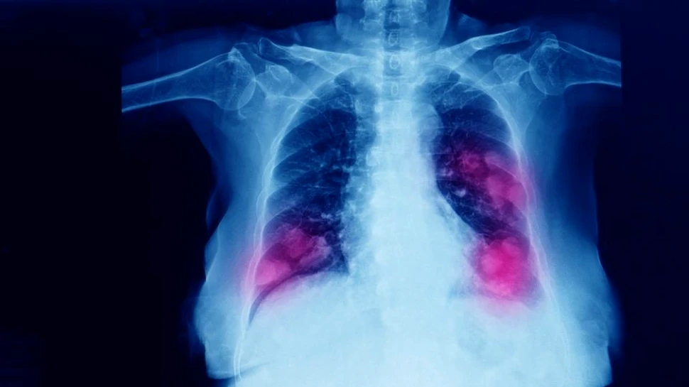 Medic de la Colentina: Infecția cu SARS-CoV-2 produce afecțiuni la nivelul tuturor organelor