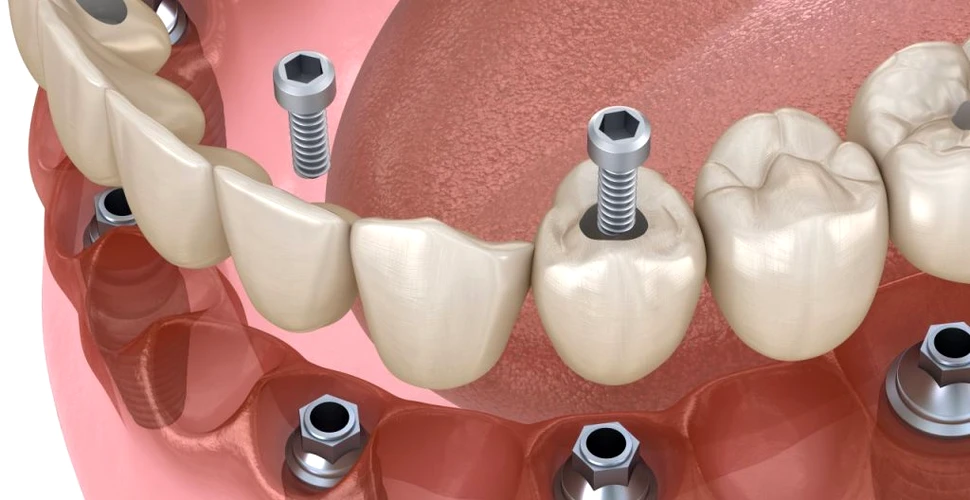 Rolul important pe care îl au suprafețele implantului dentar în fixarea țesuturilor, evitând bacteriile nedorite