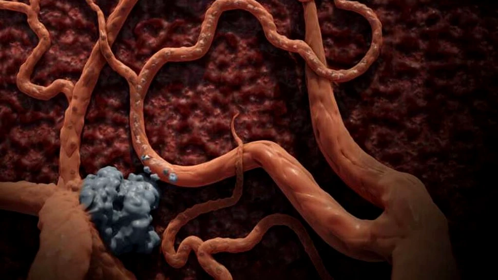 De ce unele forme de cancer nu sunt eliminate de imunoterapie?