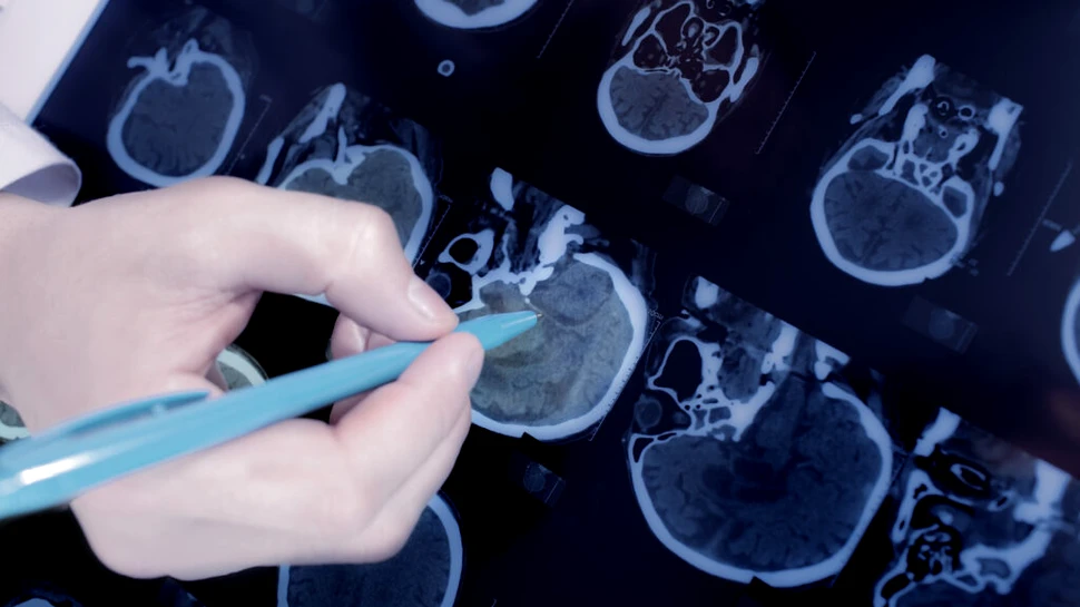 O formă severă de COVID-19 are un impact cognitiv echivalent cu 20 de ani de îmbătrânire