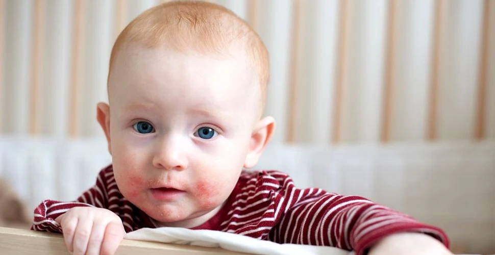 Simptomele dermatitei atopice la nou-născuţi