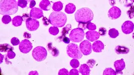Cazurile de cancer în rândul celor de sub 50 de ani, problemă tot mai îngrijorătoare