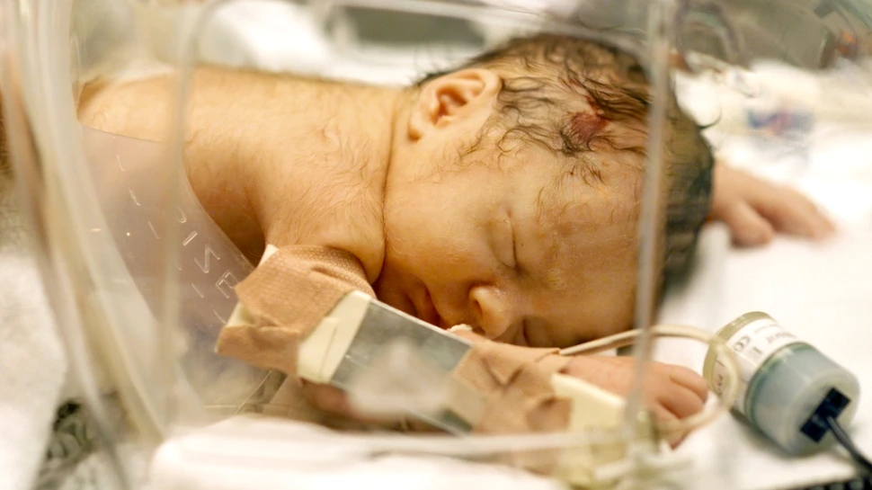 Un bebeluş s-a născut cu o „coadă” lungă de 12 cm. Ce era de fapt această excrescenţă? (FOTO)