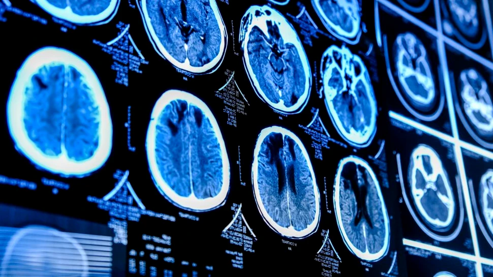 Un tratament experimental a redus la jumătate o tumoare cerebrală