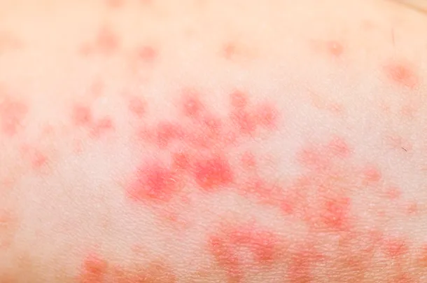 Dermatita de contact se referă la orice tip de afecţiune provocată de contactul cu plante şi produse alergenice - riscul fiind prin urmare mai crescut când mergeţi în vacanţă cu cortul