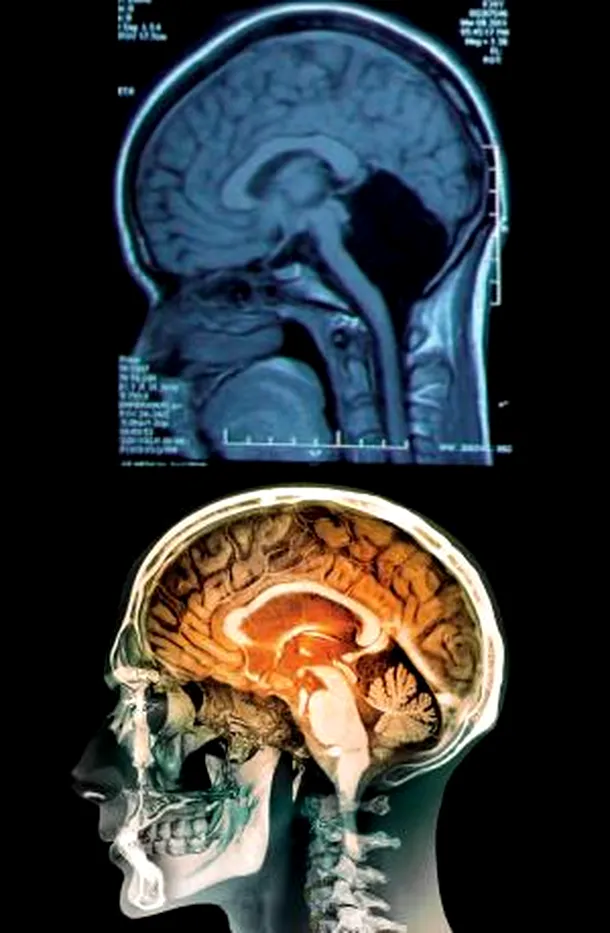 Tomografia pacientei fără cerebel (sus) comparativ cu tomografia unui creier normal (jos)