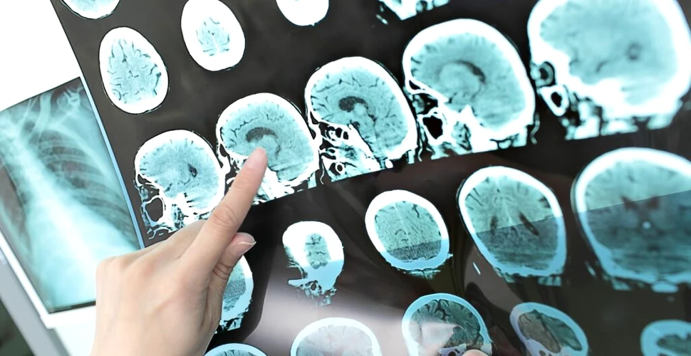 Cercetătorii au identificat 15 factori asociați cu riscul de demență timpurie
