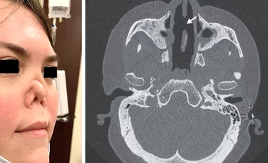 Nasul unei femei s-a prăbușit și s-a „scufundat” în față din cauza unei boli autoimune rare
