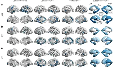 Locul unde acumulezi grăsimea corporală influențează direct îmbătrânirea creierului