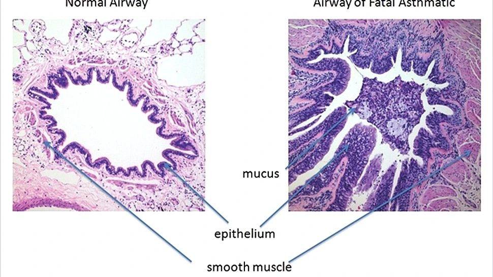 O nouă descoperire ar putea duce la eliminarea crizelor de astm