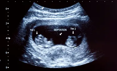 O femeie cu două utere a adus pe lume încă doi gemeni la o lună după ce a născut un băieţel