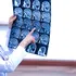 O metodă ingenioasă deschide o cale nouă de a detecta leziunile cerebrale după AVC