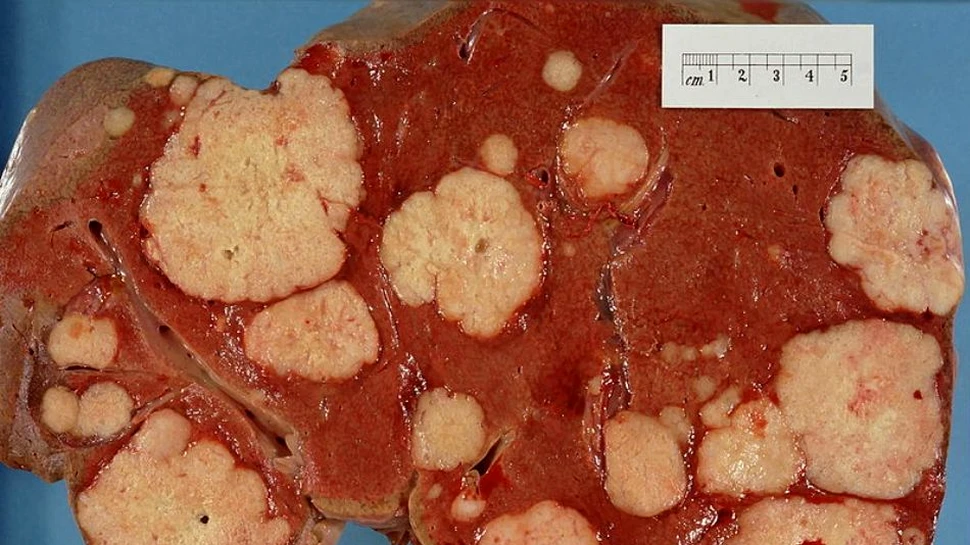Un “nas” artificial performant poate detecta cancerul metastatic, cu o precizie remarcabilă
