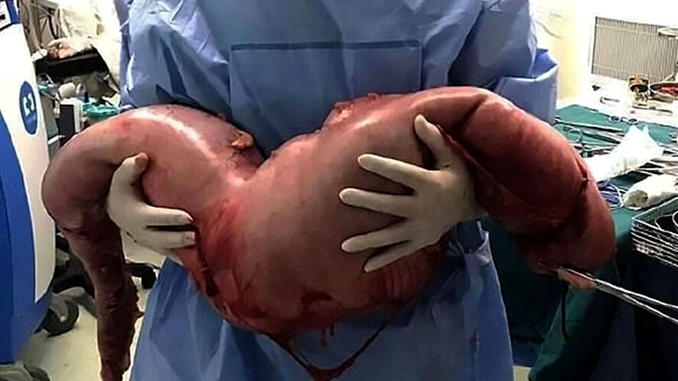 Descoperire şocantă în corpul unui bărbat. Avea 13 kilograme şi reprezintă un caz rar în lumea medicală – FOTO