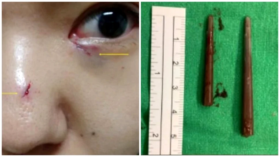 O femeie a avut, fără să știe, bețișoare blocate în sinusuri timp de o săptămână