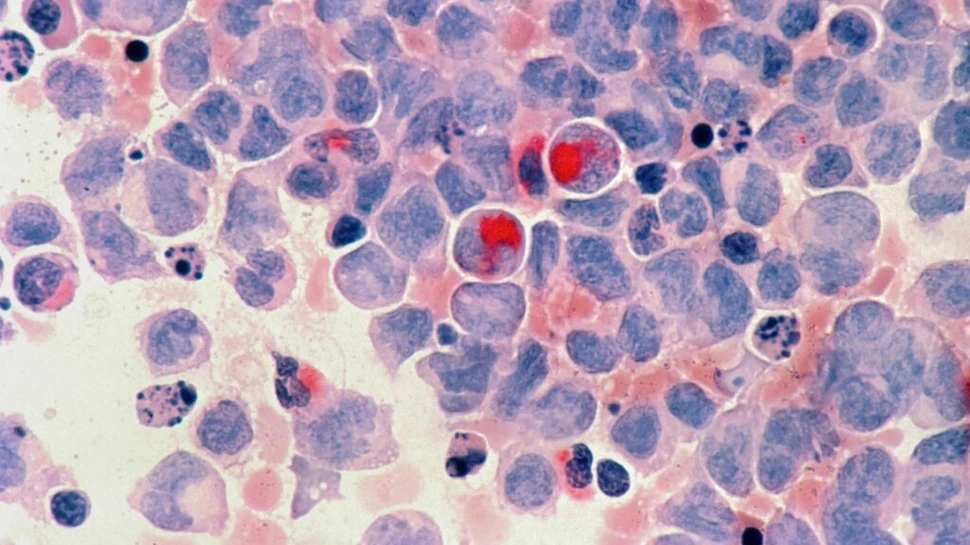 Un nou tratament împotriva cancerului se bazează pe eliminarea reziduurilor celulare din organism