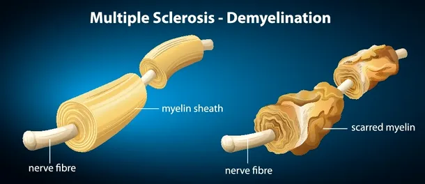 Scleroza multiplă este caracterizată de permeabilitatea hematoencefalică şi demielinizare - un proces în care teaca de mielină a neuronilor este afectată.