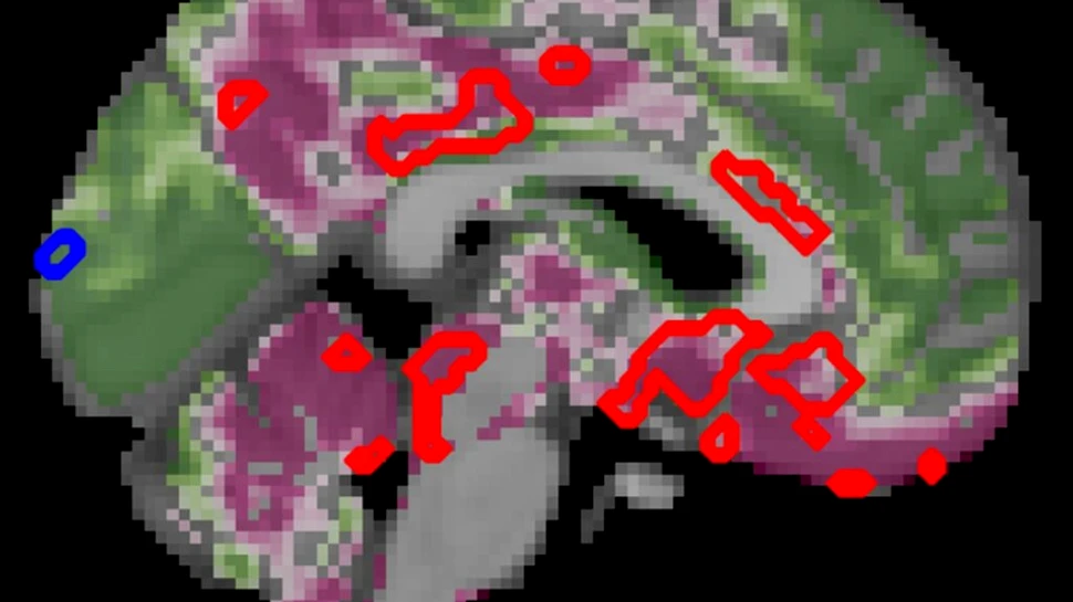 Diabetul de tip 2 accelerează îmbătrânirea creierului și declinul cognitiv