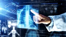 Radiografiile toracice ajută la diagnosticul timpuriu al cancerului pulmonar