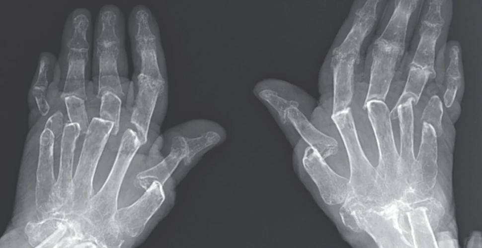 Caz medical neobişnuit: degetele unei femei se micşorează din cauza unei afecţiuni rare