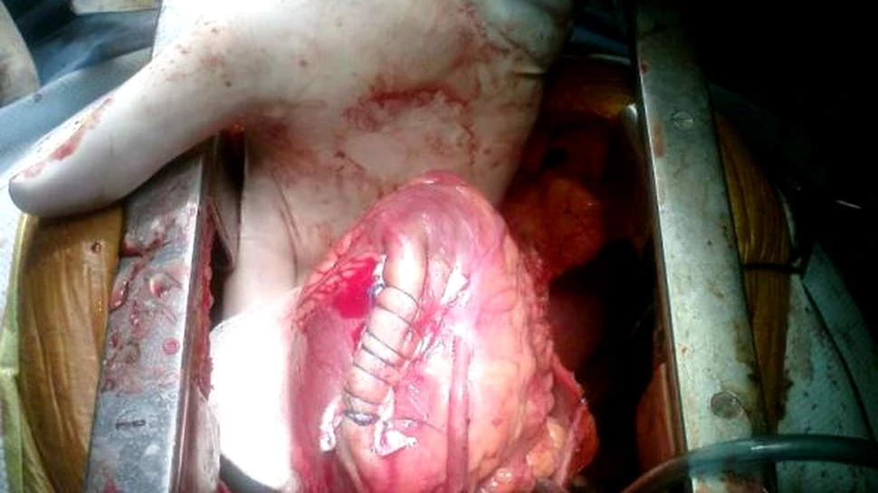 Chirurgii au creat un muschi coronarian din maduva