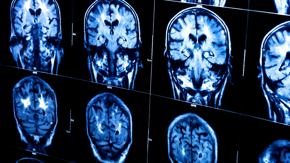 O nouă formă genetică a bolii Alzheimer a fost identificată la persoanele cu un factor de risc comun