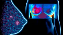 Cum s-ar putea încetini evoluţia cancerului de sân triplu negativ
