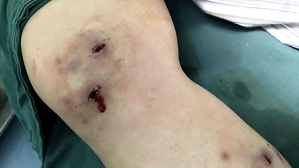 O femeie a trecut prin clipe îngrozitoare când un vierme a ieşit din genunchiul acesteia după o călătorie în Brazilia – FOTO