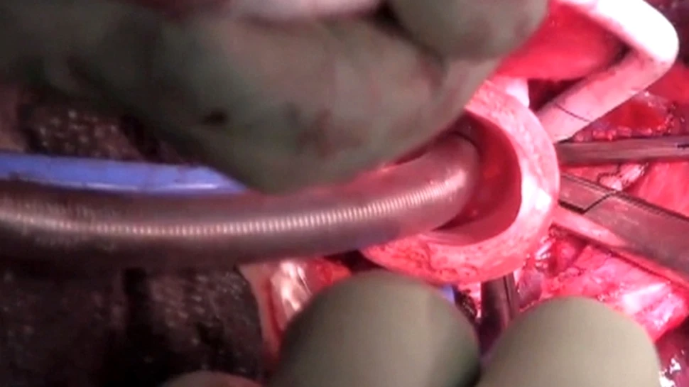 Pentru prima dată în istorie a fost efectuat transplantul unui organ sintetic (VIDEO)