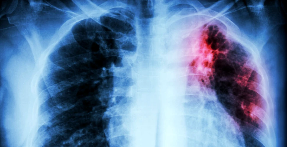 Inteligența Artificială a creat un nou medicament pentru fibroza pulmonară