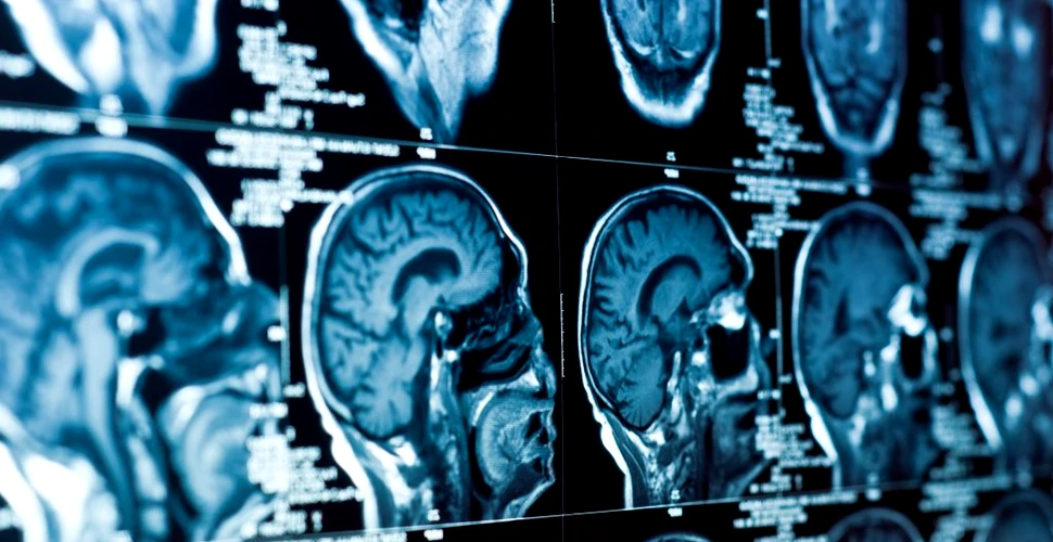 O boală misterioasă a creierului îi îngrijorează pe medicii din Canada