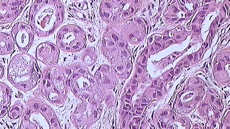 A fost dezvoltată o metodă ingenioasă de distrugere a cancerului