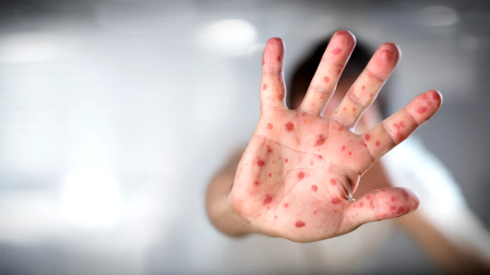 Cazurile de rujeolă au crescut cu aproape 80% în urma haosului creat de COVID-19