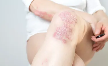 Psoriazisul, una dintre cele mai răspândite boli de piele, ar putea fi tratat printr-o nouă tehnică